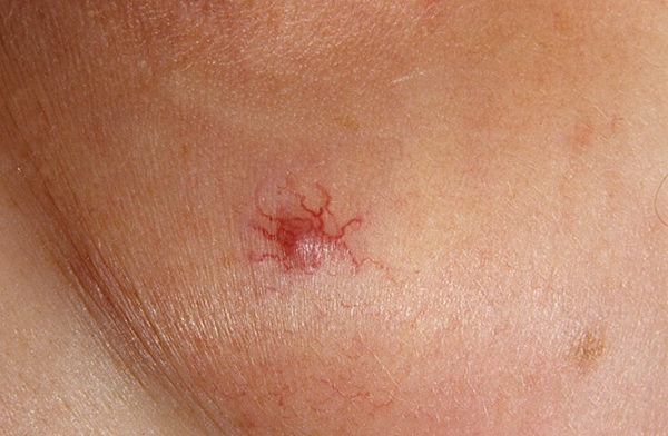 Красное пятно на спине болит фото thumbnail
