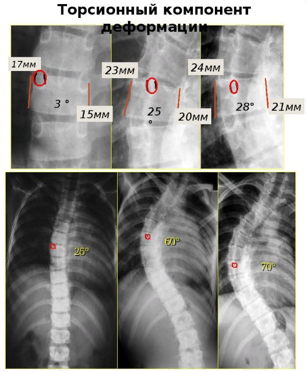 Поворот позвонков. Степени ротации тел позвонков рентген. Ротация позвонков рентген. Ротация тел позвонков l2 , l3влево. Сколиоз с ротацией позвонков.