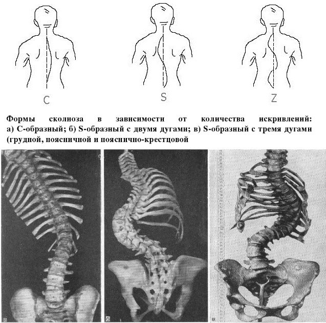 Нервно мышечный сколиоз клинические рекомендации