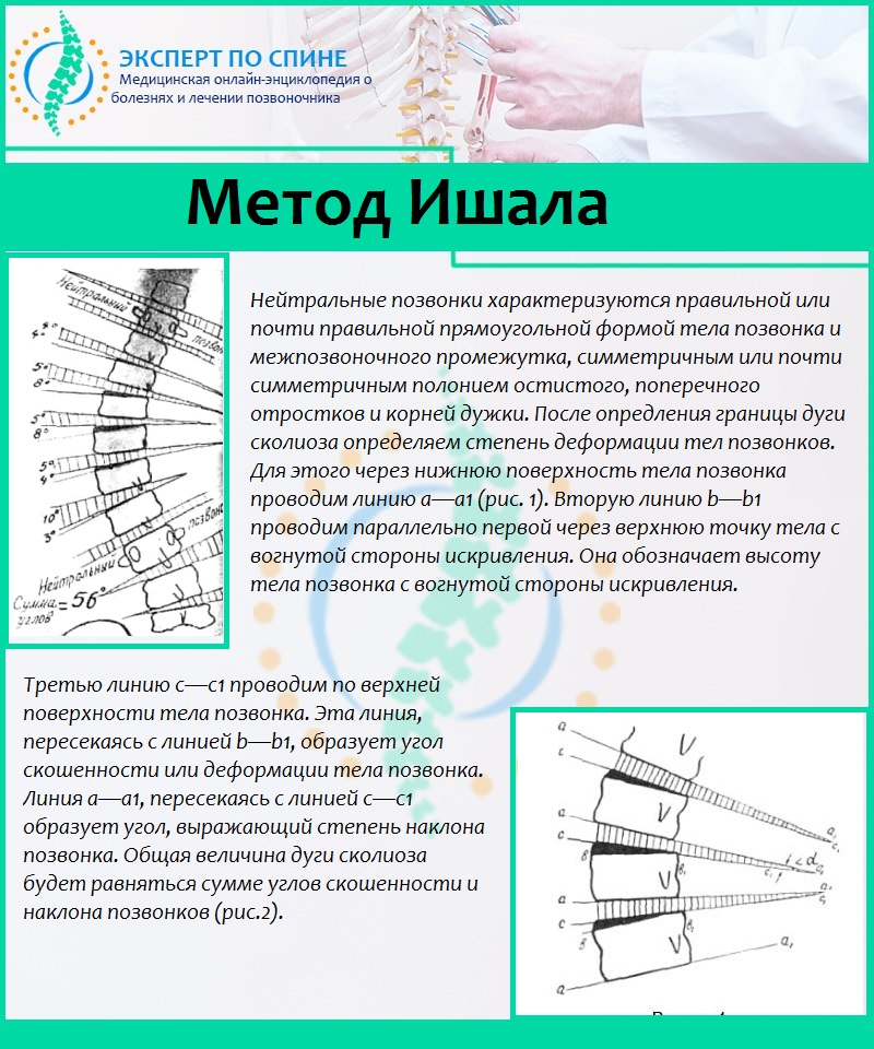 Миостимуляция при сколиозе схема