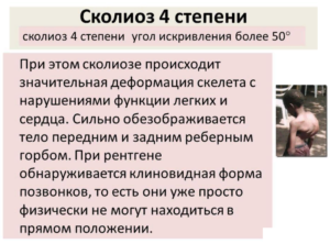 4 степень – отклонение больше 50 градусов