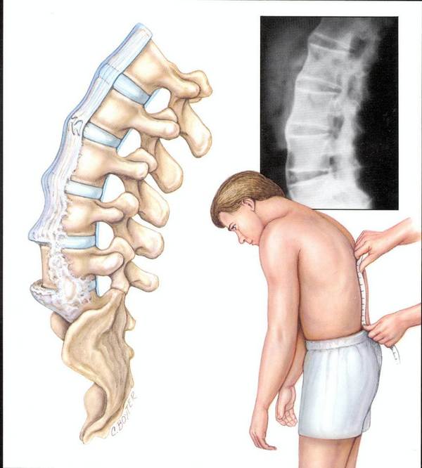 При артрите ощущается сильная боль в спине и ощущения, похожие на трение костей