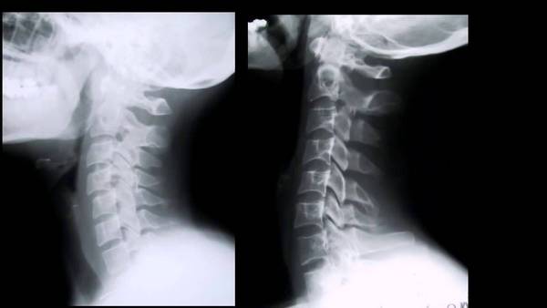 Чтобы подтвердить диагноз, необходимо провести рентген шеи в боковой проекции