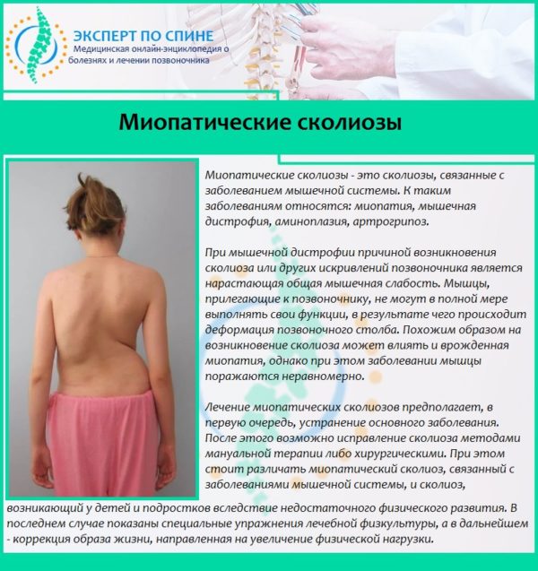 Миопатические сколиозы