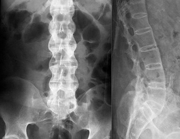 При заболеваниях позвоночника чаще всего для диагностики применяют рентгенографию
