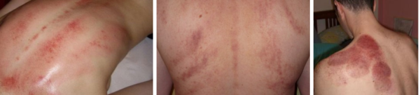 При частом проведении баночного массажа на коже могут оставаться пятна и кровоподтеки от банок