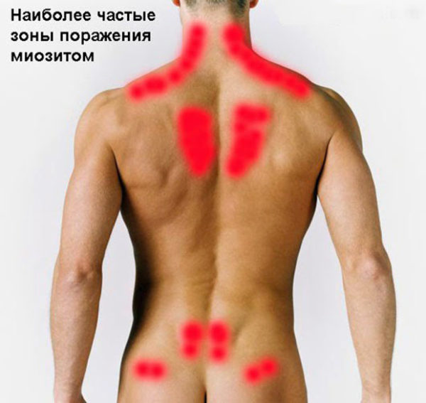 Зоны спины, наиболее часто поражающиеся миозитом
