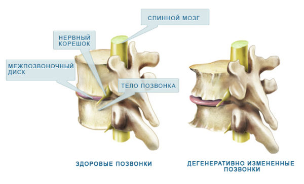 Как изменяются части позвоночника при остеоартрозе