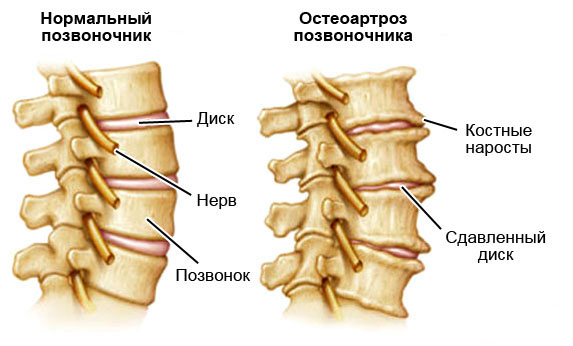 Схематичное изображение остеоартроза позвоночника