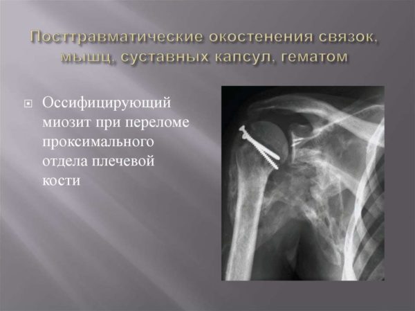Оссифицирующий миозит при переломе проксимального отдела плечевой кости на рентгене