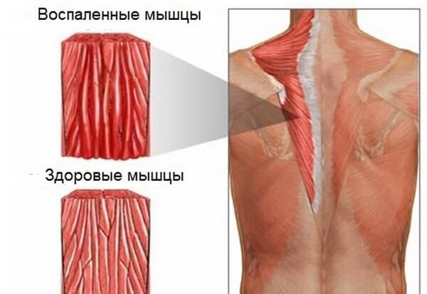 Воспаленные мышцы при миозите