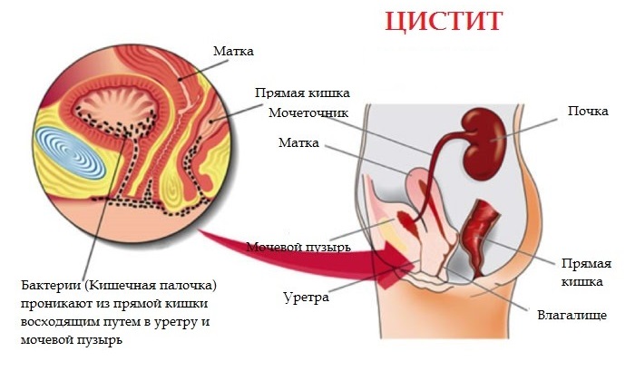рези при мочеиспускании у женщин и частое мочеиспускание. степени наполнения мочевого пузыря. мочеиспускание перед месячными. мочеиспускание схема. цистит у женщин симптомы.