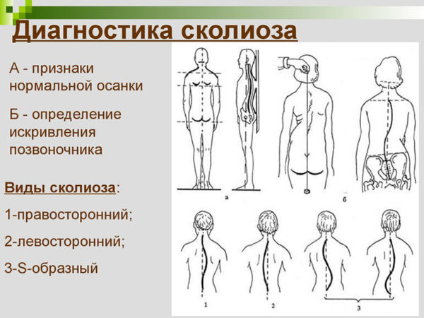 Диагностика сколиоза