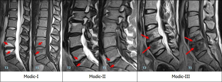 Остеосклероз поясничного отдела. Отек костного мозга тел смежных позвонков. Modic классификация мрт. Субхондральный остеосклероз замыкательных пластинок l4-s1. Modic 1 2 3 мрт.