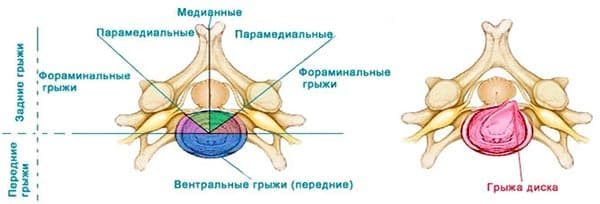 Классификации межпозвоночных грыж