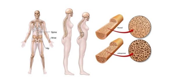 Остеопороз