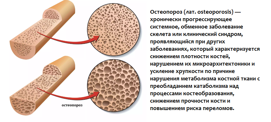 Остеопороз это