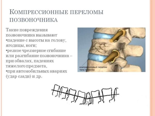 Причины компрессионного перелома позвоночника