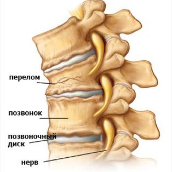 Разрушение части костной ткани при переломе позвоночника