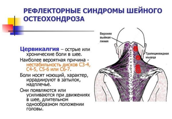 Синдромы шейного остеохондроза