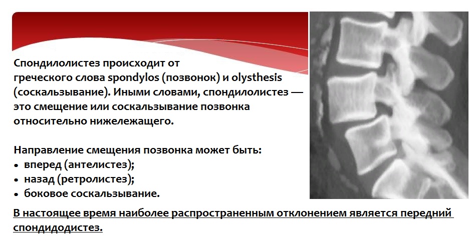 Спондилолистез. Спондилолистез степени рентген. Спондилолистез 4 позвонка 1 степени. Смещение тела позвонка кпереди. Спондилолистез – смещение позвонков.