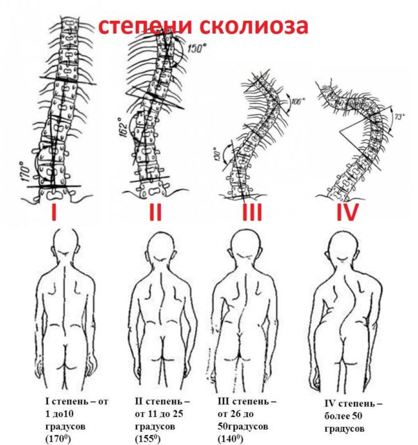 Степени сколиоза