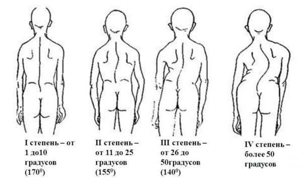 Степени сколиоза