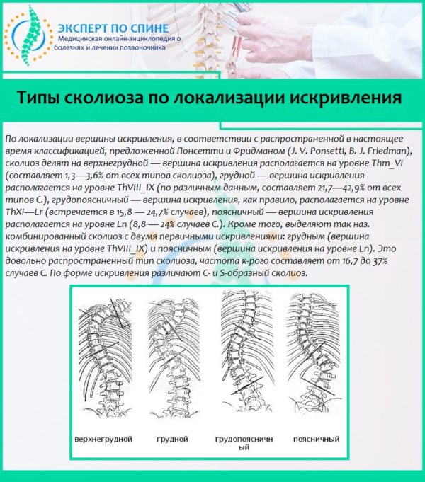 Типы сколиоза по локализации искривления