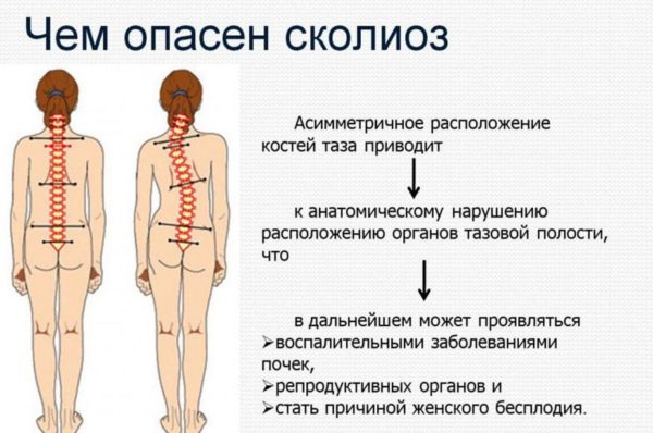 Чем опасен сколиоз