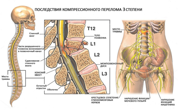 Что происходит в организме при переломе позвоночника 3 степени