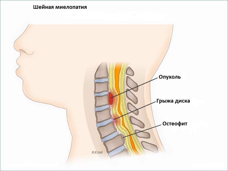 Остеохондроз шейный нерв. Гемангиома позвоночника шейного отдела. Миелопатия с5-с6. Миелопатия шейного отдела позвоночника с5 с с6. Люмбальная миелопатия.