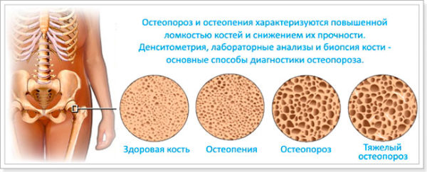 Остеопения и остеопороз: разница