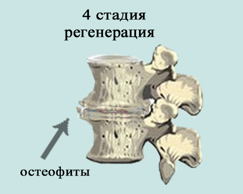 Остеохондроз позвоночника инвалидность. Остеохондроз 4 степени. 4 Стадия остеохондроза. Стадии остеохондроза. Четвертая стадия остеохондроза.