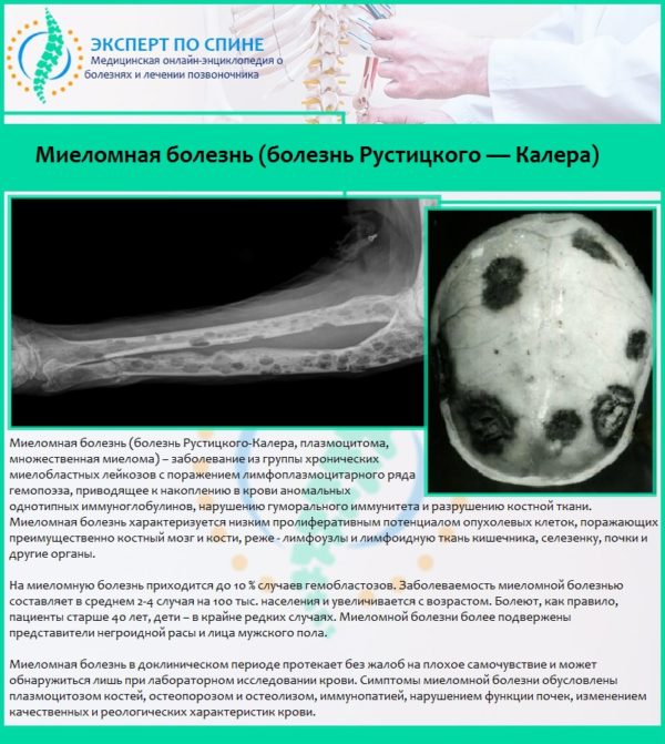 Миеломная болезнь (болезнь Рустицкого — Калера)