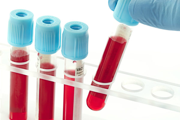 Анализ крови позволяет установить наличие аутоиммунных заболеваний 