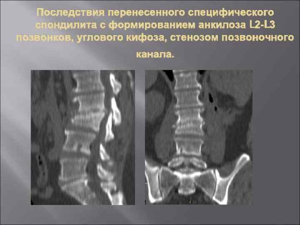 Анкилоз позвонков на рентгене