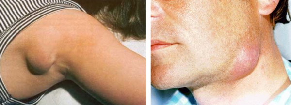 При воспалении лимфоузлов под кожей появляются подвижные болезненные бугорки