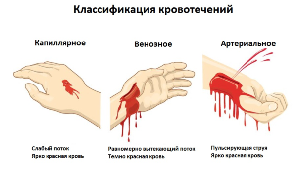 Как определить вид кровотечения