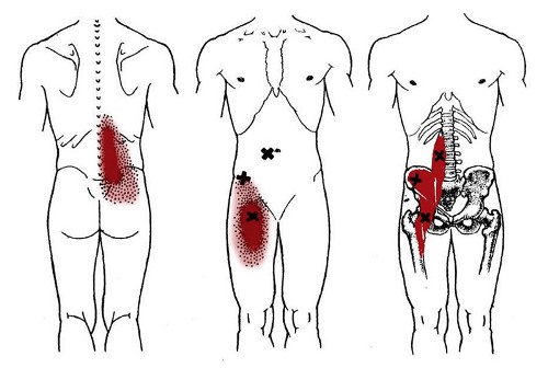 Локализация болей при воспалении подвздошно-поясничной мышцы