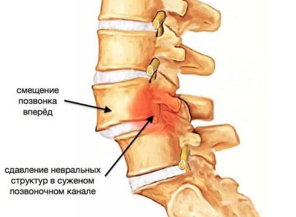 Механические травмы шеи могут спровоцировать хруст в шее