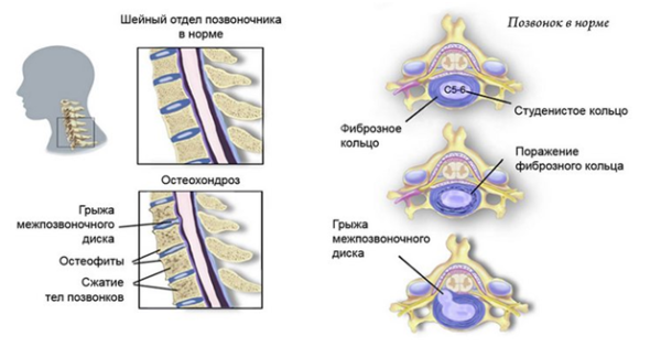 Наглядное изображение шейного остеохондроза