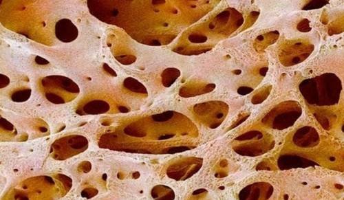 Что такое остеосклероз? Что такое остеосклероз и как лечить уплотнение костей