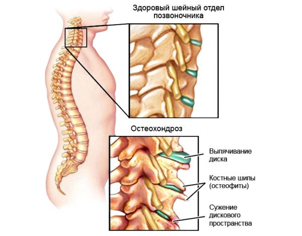 Панические атаки при шейном или грудном остеохондрозе: симптомы, взаимосвязь, приступы паники