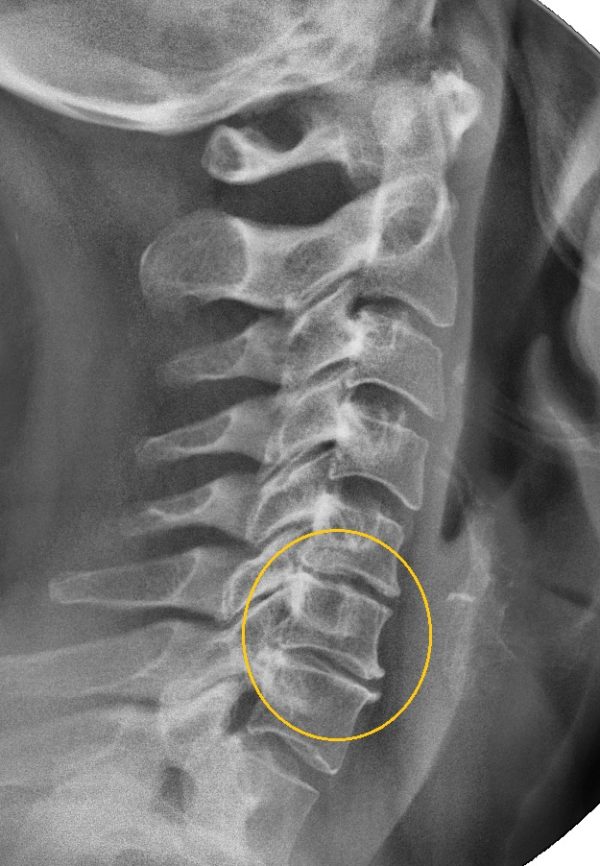 Полисегментарный остеохондроз на рентгеновском снимке