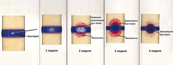Развиваться спондилодисцит начинает внутри хрящевой ткани позвоночника