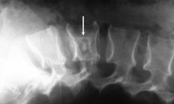 Рентгеновский снимок саркомы позвоночника
