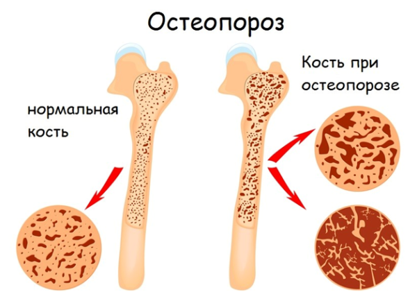 Состояние костей при остеопорозе