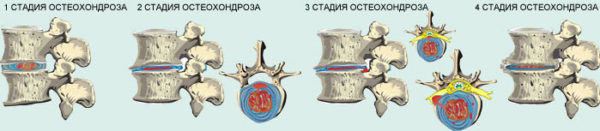 Стадии остеохондроза позвоночника