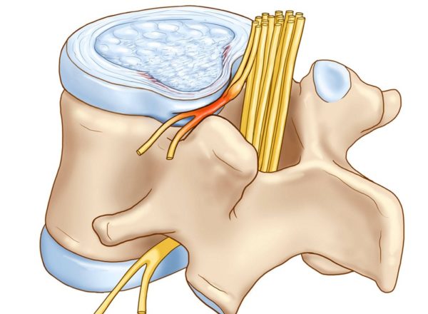 Схематичное изображение защемления нерва в спине