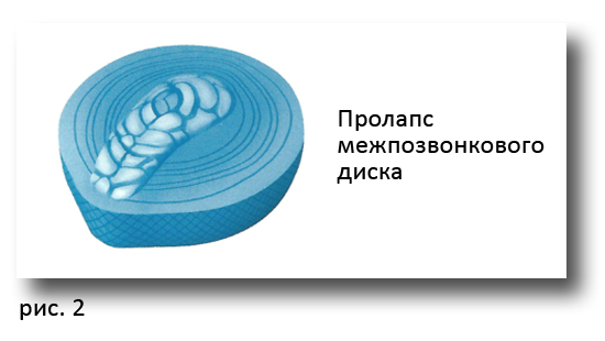 Схематичное изображение пролапса межпозвоночного диска